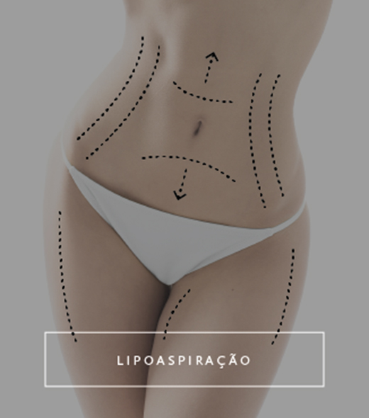 Tudo que você precisa saber sobre Lipoaspiração